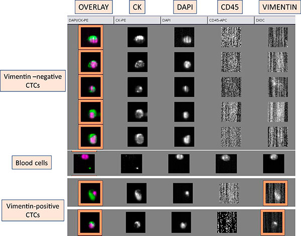 Epithelial To Mesenchymal Transition Of Tumor Cells Cancer Progression